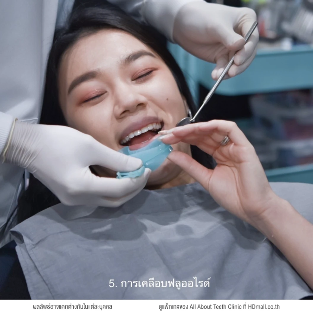 ฟอกสีฟัน 5 ขั้นตอน (โปรแกรม Wink & White Super Set) 1 ครั้ง