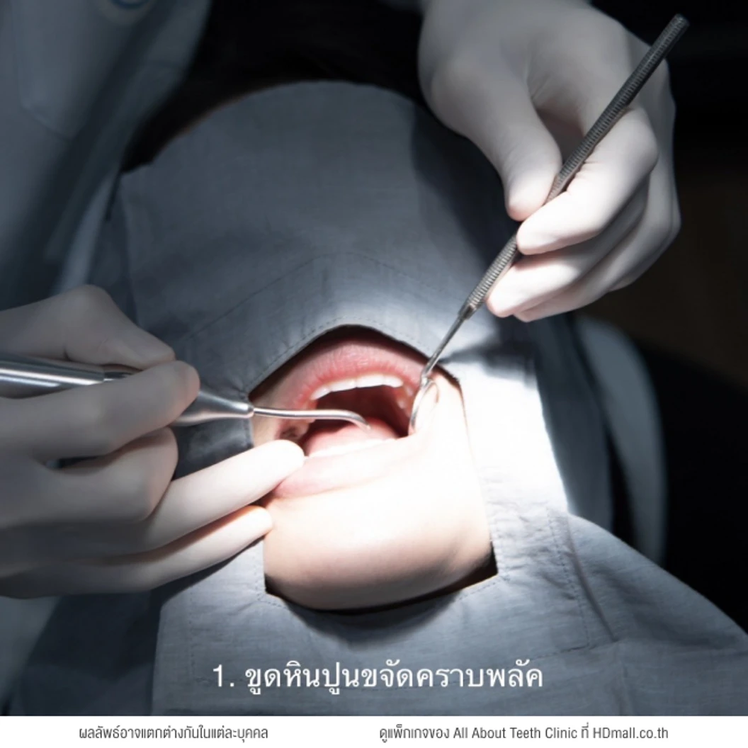 ฟอกสีฟัน 5 ขั้นตอน (โปรแกรม Wink & White Super Set) 1 ครั้ง
