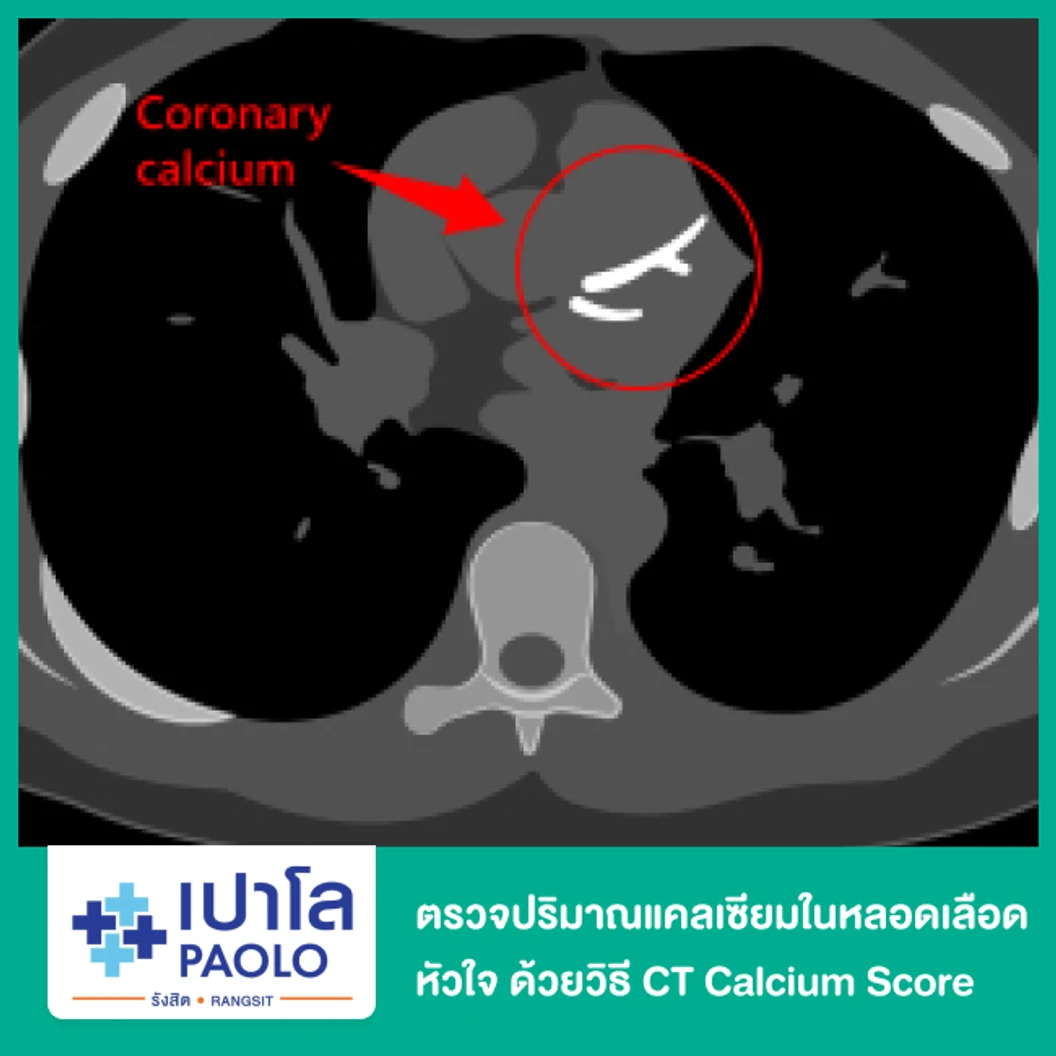 ตรวจปริมาณแคลเซียมในหลอดเลือดหัวใจ ด้วยวิธี CT Calcium Score ที่ โรงพยาบาลเปาโล รังสิต