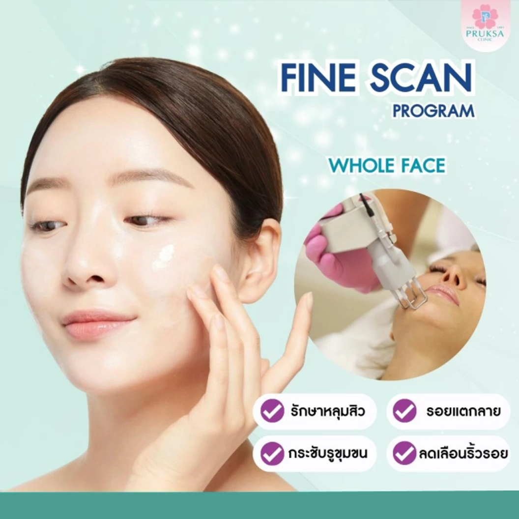 เลเซอร์หน้าด้วย Fine Scan Laser เพื่อรักษารอยสิวทั่วใบหน้า 1 ครั้ง ฟรี! 1 ครั้ง