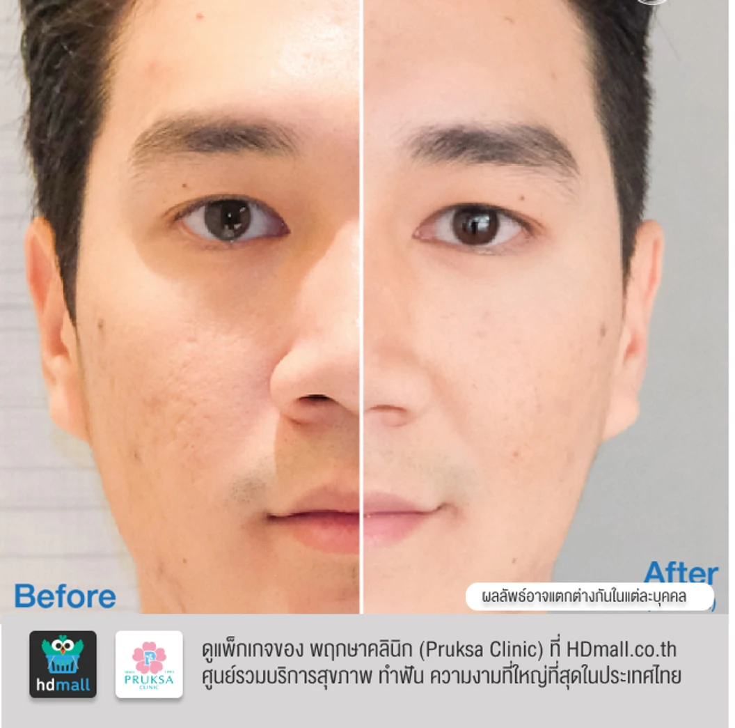 เลเซอร์ E-Matrix แก้ปัญหาหลุมสิว ผิวขรุขระ รูขุมขนกว้าง 100 ช็อต 1 ครั้ง