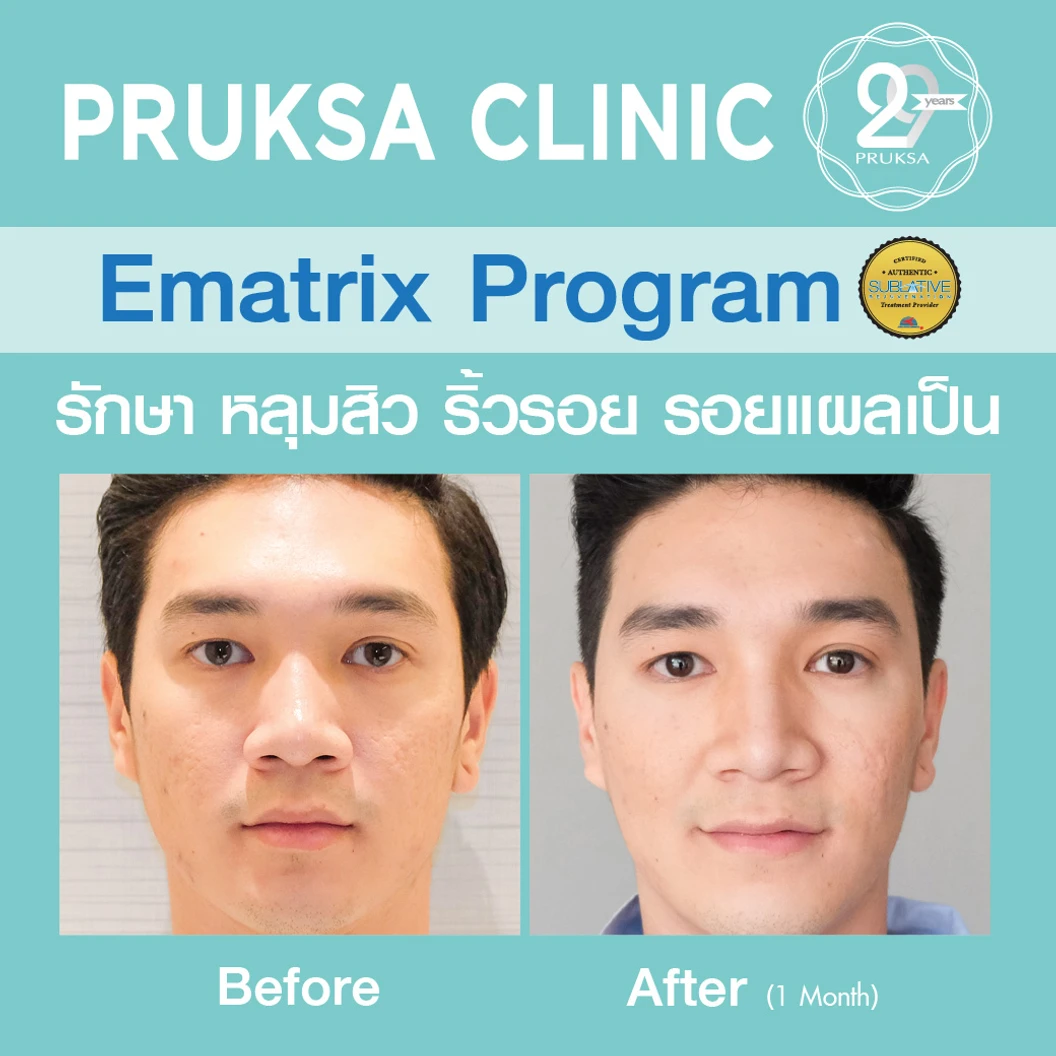 เลเซอร์ E-Matrix แก้ปัญหาหลุมสิว ผิวขรุขระ รูขุมขนกว้าง 100 ช็อต 1 ครั้ง