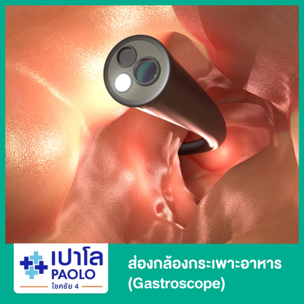 ส่องกล้องกระเพาะอาหาร (Gastroscope)
