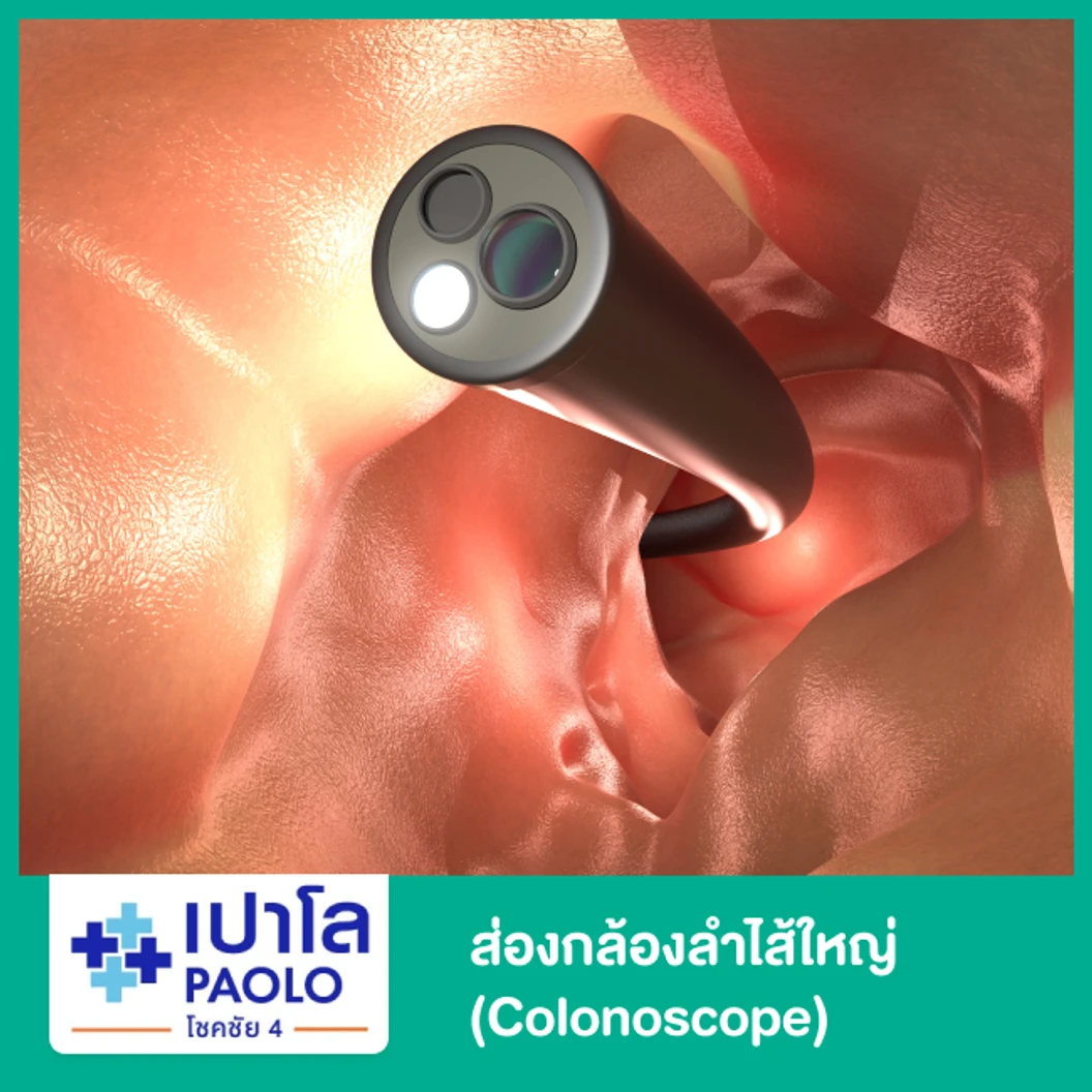 ส่องกล้องลำไส้ใหญ่ (Colonoscope)
