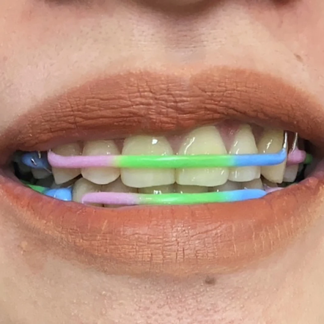 ทำรีเทนเนอร์แบบลวด 2 ชิ้น ฟันบนและล่าง