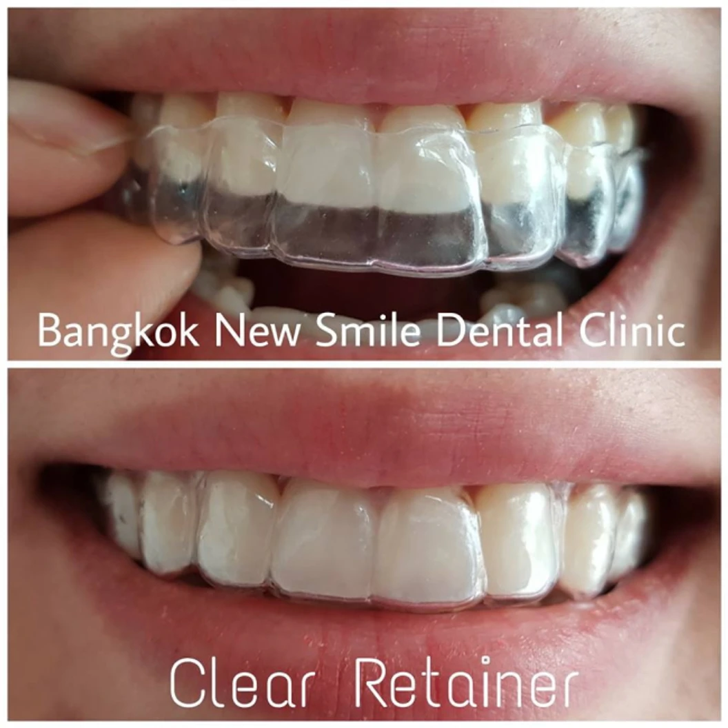 ทำรีเทนเนอร์แบบใส 2 ชิ้น สำหรับฟันบนและล่าง พร้อมขูดหินปูน