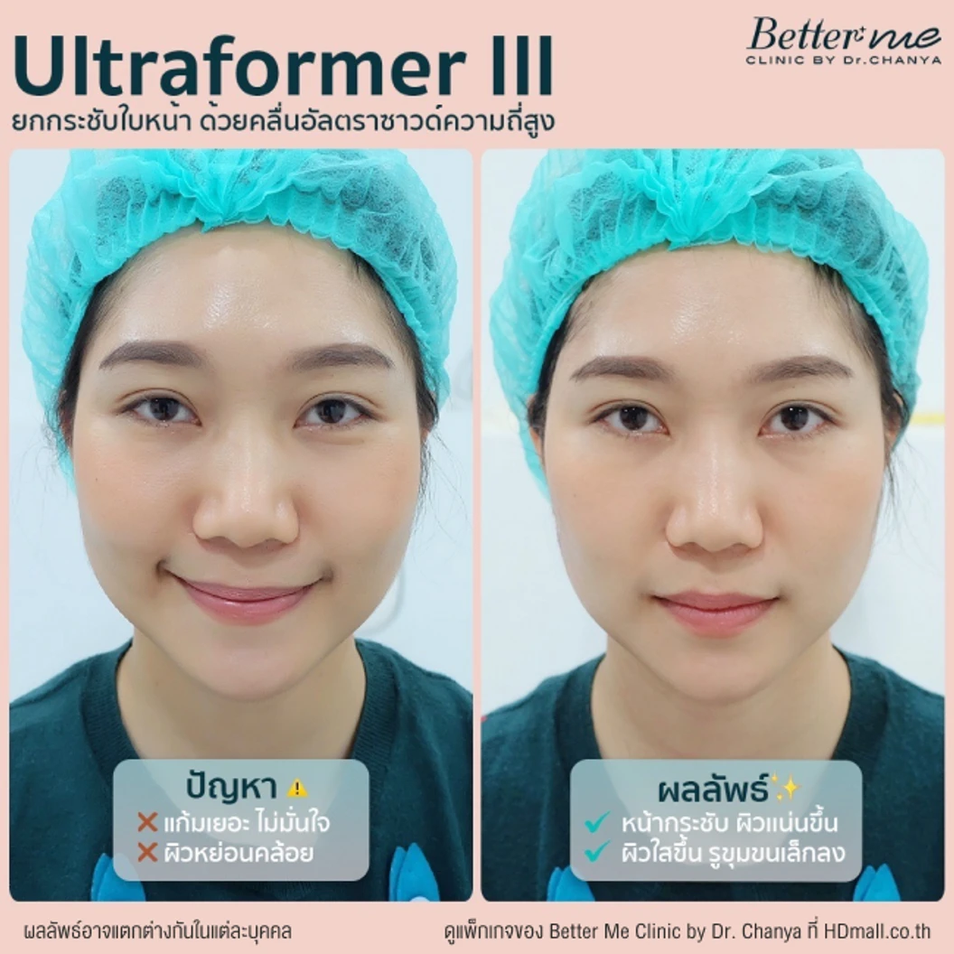 ทำ HIFU ด้วยเครื่อง Ultraformer lll 100 ช็อต บริเวณที่มีปัญหา 1 ครั้ง