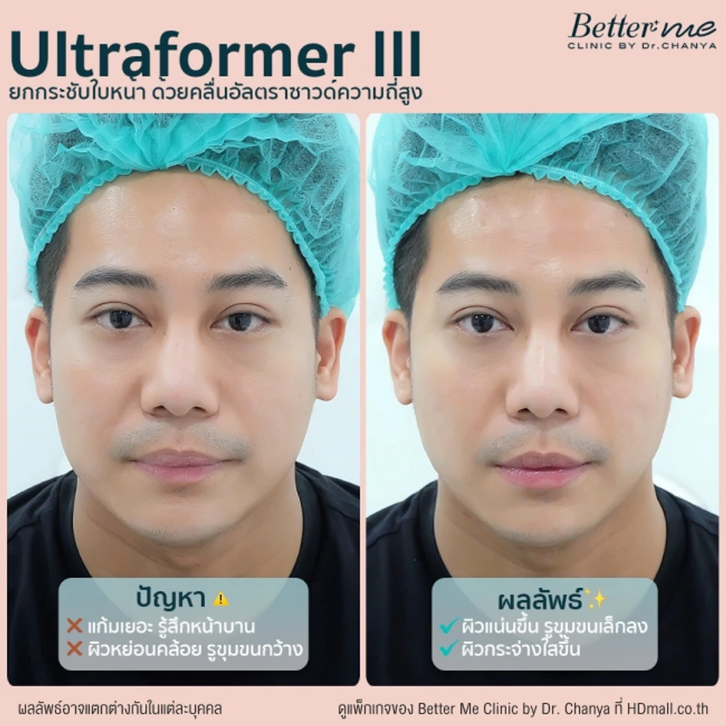 ทำ HIFU ด้วยเครื่อง Ultraformer lll 200 ช็อต บริเวณที่มีปัญหา 1 ครั้ง