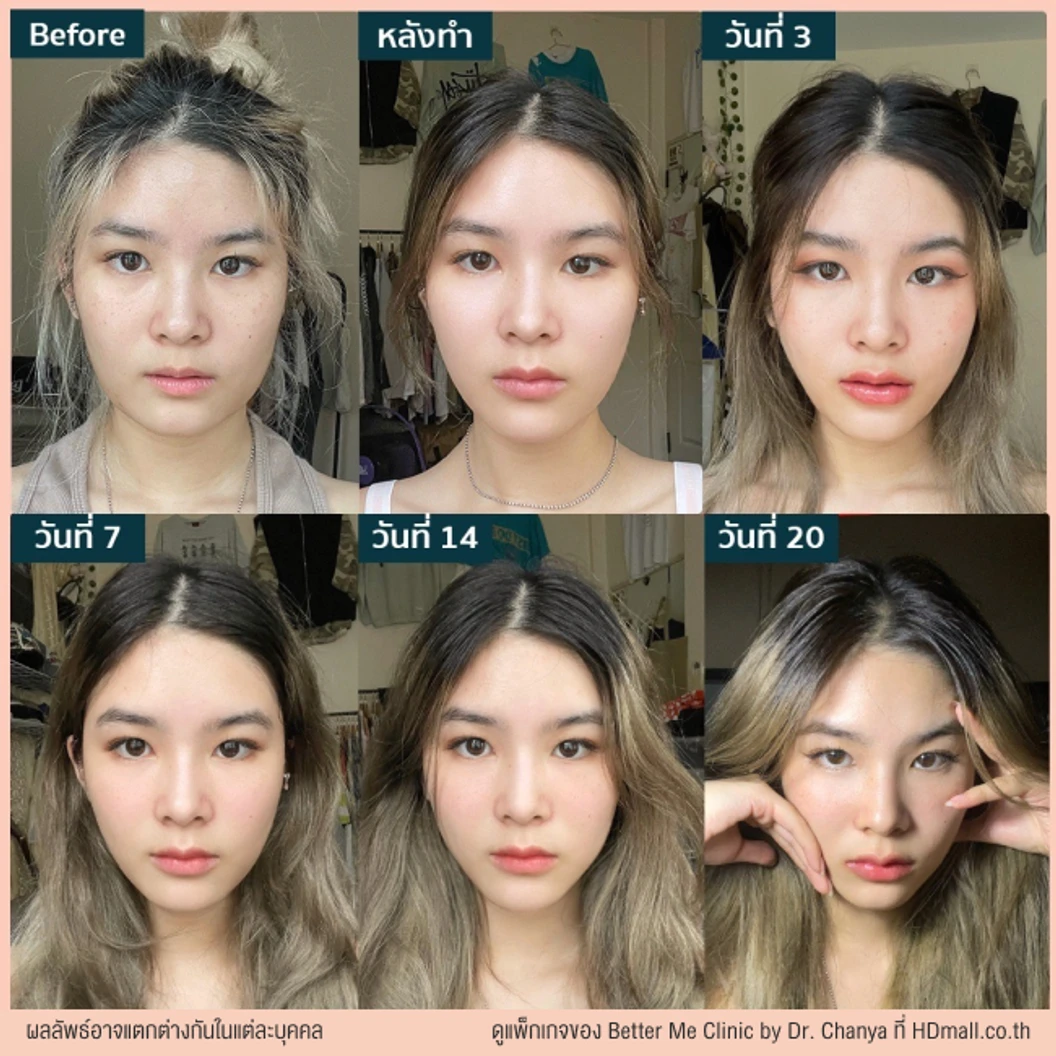 ทำ HIFU ด้วยเครื่อง Ultraformer lll 200 ช็อต บริเวณที่มีปัญหา 1 ครั้ง