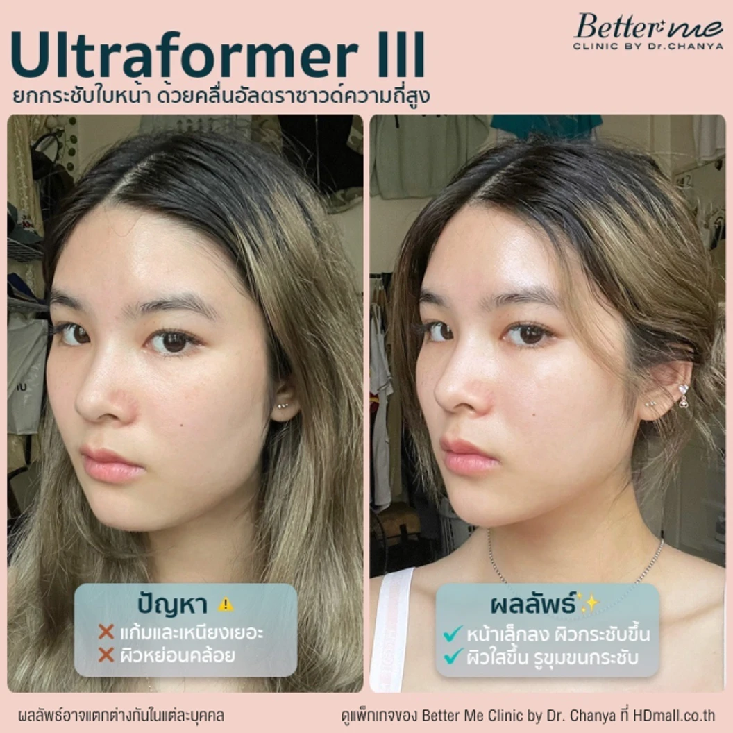 ยกกระชับใบหน้า ด้วยเครื่อง Ultraformer lll 300 ช็อต บริเวณที่มีปัญหา 1 ครั้ง