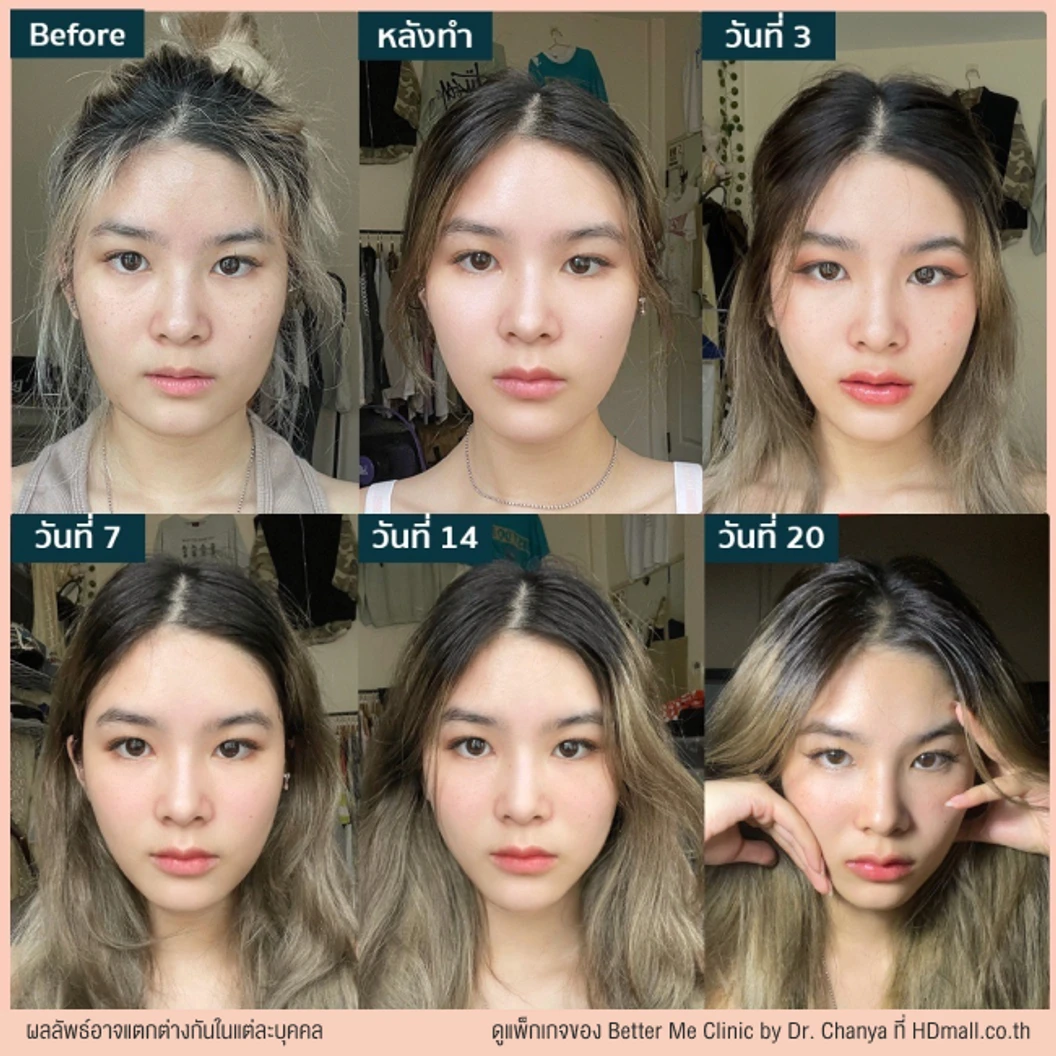 ยกกระชับใบหน้า ด้วยเครื่อง Ultraformer lll 1,000 ช็อต ฟรี! 200 ช็อต บริเวณที่มีปัญหา 1 ครั้ง