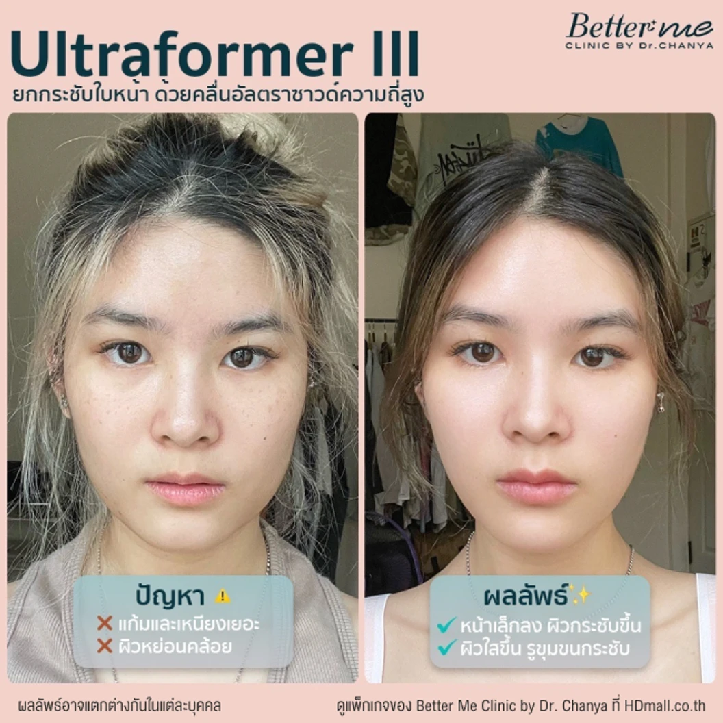 ยกกระชับใบหน้า ด้วยเครื่อง Ultraformer lll 1,000 ช็อต ฟรี! 200 ช็อต บริเวณที่มีปัญหา 1 ครั้ง
