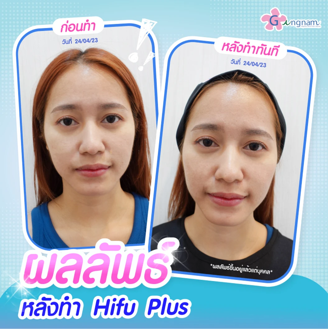 ทำ HIFU เครื่อง Ultra V HIFU Plus ไม่จำกัดช็อต บริเวณแก้มและร่องแก้ม 1 ครั้ง