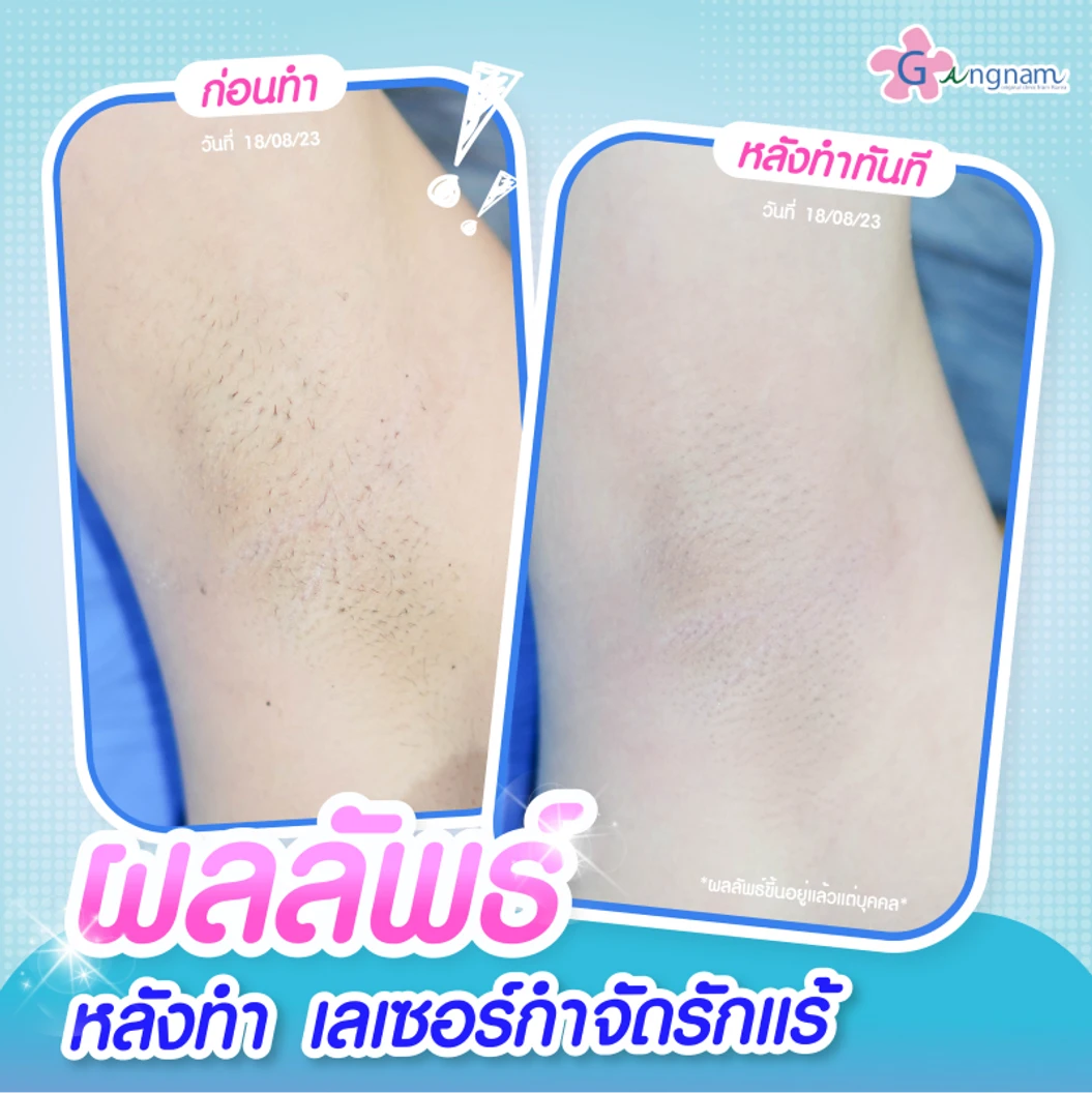 เลเซอร์ Long Pulse Nd:YAG กำจัดขนรักแร้ 1 ครั้ง (1 สิทธิ์/ท่าน)