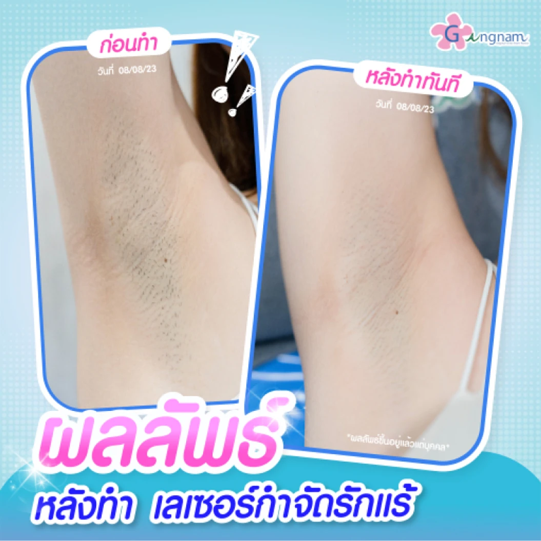 เลเซอร์ Long Pulse Nd:YAG กำจัดขนรักแร้ 1 ครั้ง (1 สิทธิ์/ท่าน)