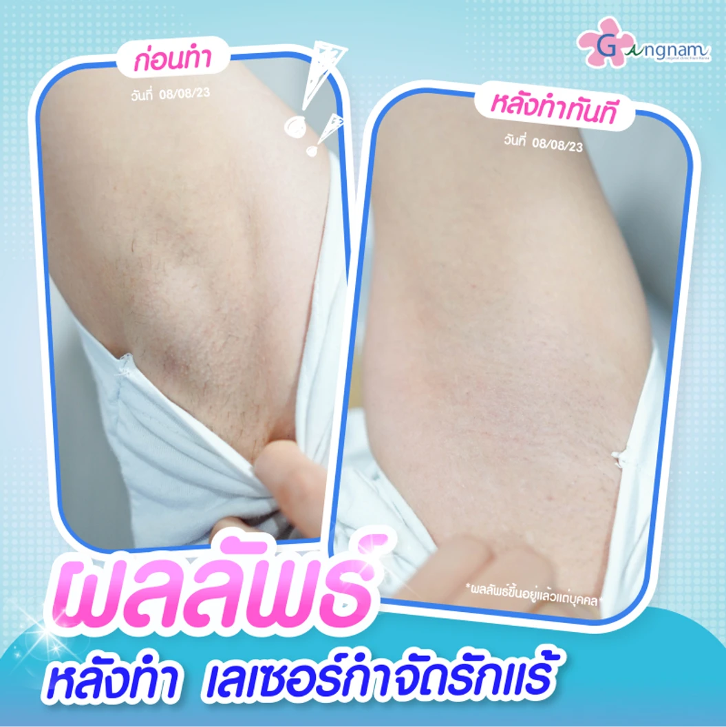 เลเซอร์ Long Pulse Nd:YAG กำจัดขนรักแร้ 1 ครั้ง (1 สิทธิ์/ท่าน)