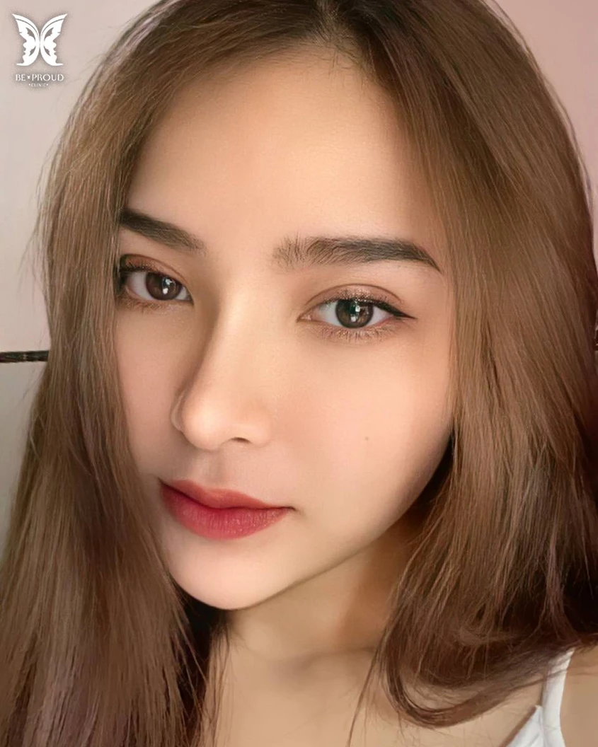 ทำตาสองชั้น แบบกรีดยาว แผลมินิ (แผลเล็กไม่ถึง 1 ซม.) ทำโดยจักษุแพทย์ สำหรับเคสทำครั้งแรกและรีวิว