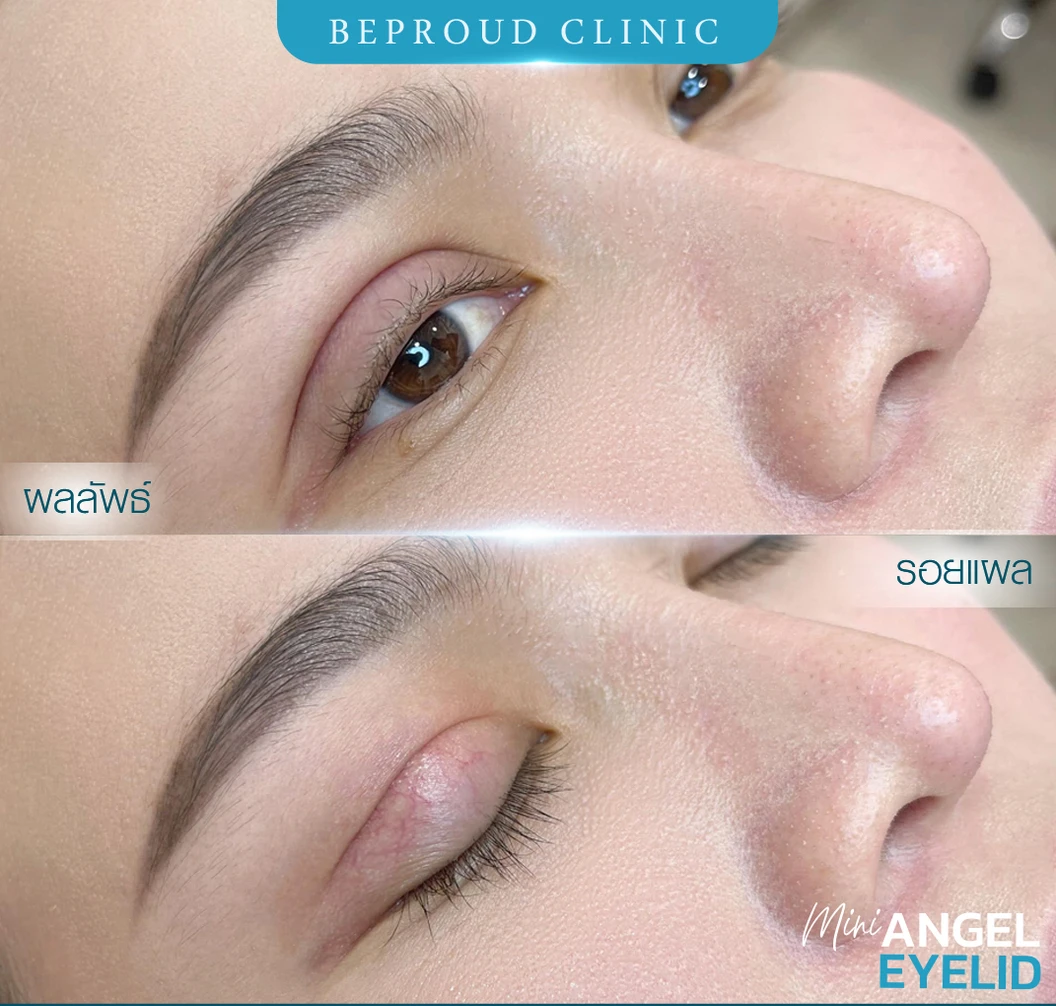 ทำตาสองชั้น แบบกรีดยาว แผลมินิ (แผลเล็กไม่ถึง 1 ซม.) ทำโดยจักษุแพทย์ สำหรับเคสทำครั้งแรกและรีวิว