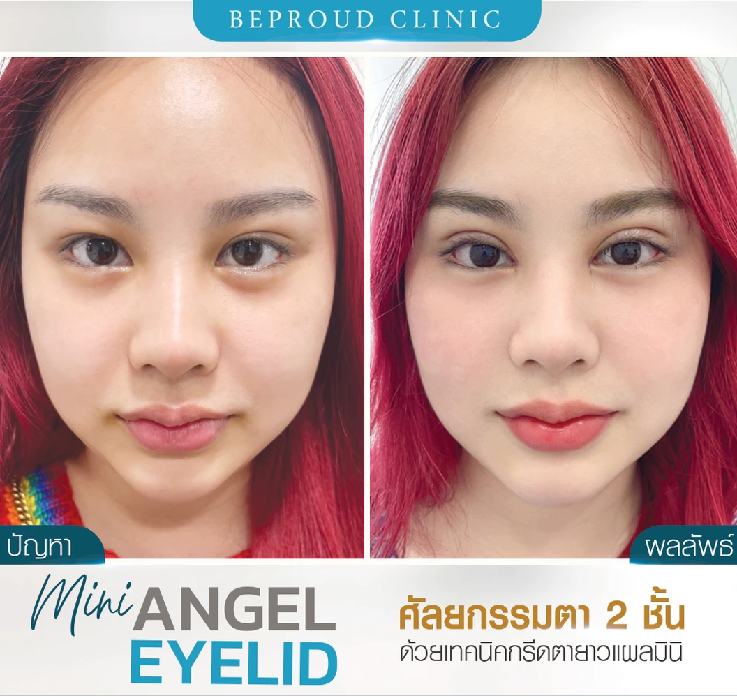 ทำตาสองชั้น แบบกรีดยาว แผลมินิ (แผลเล็กไม่ถึง 1 ซม.) ทำโดยจักษุแพทย์ สำหรับเคสทำครั้งแรกและรีวิว