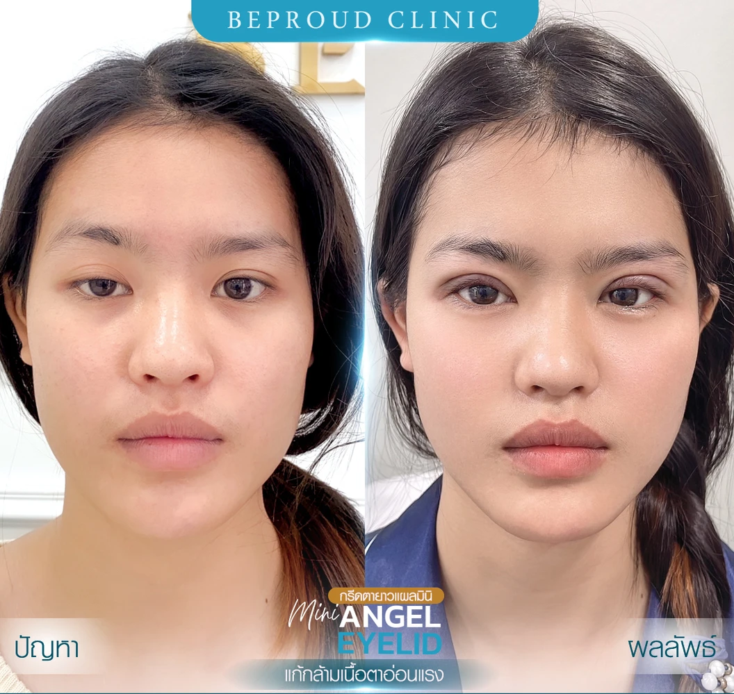 ทำตาสองชั้น แบบกรีดยาว แผลมินิ (แผลเล็กไม่ถึง 1 ซม.) สำหรับเคสทำครั้งแรกและรีวิว