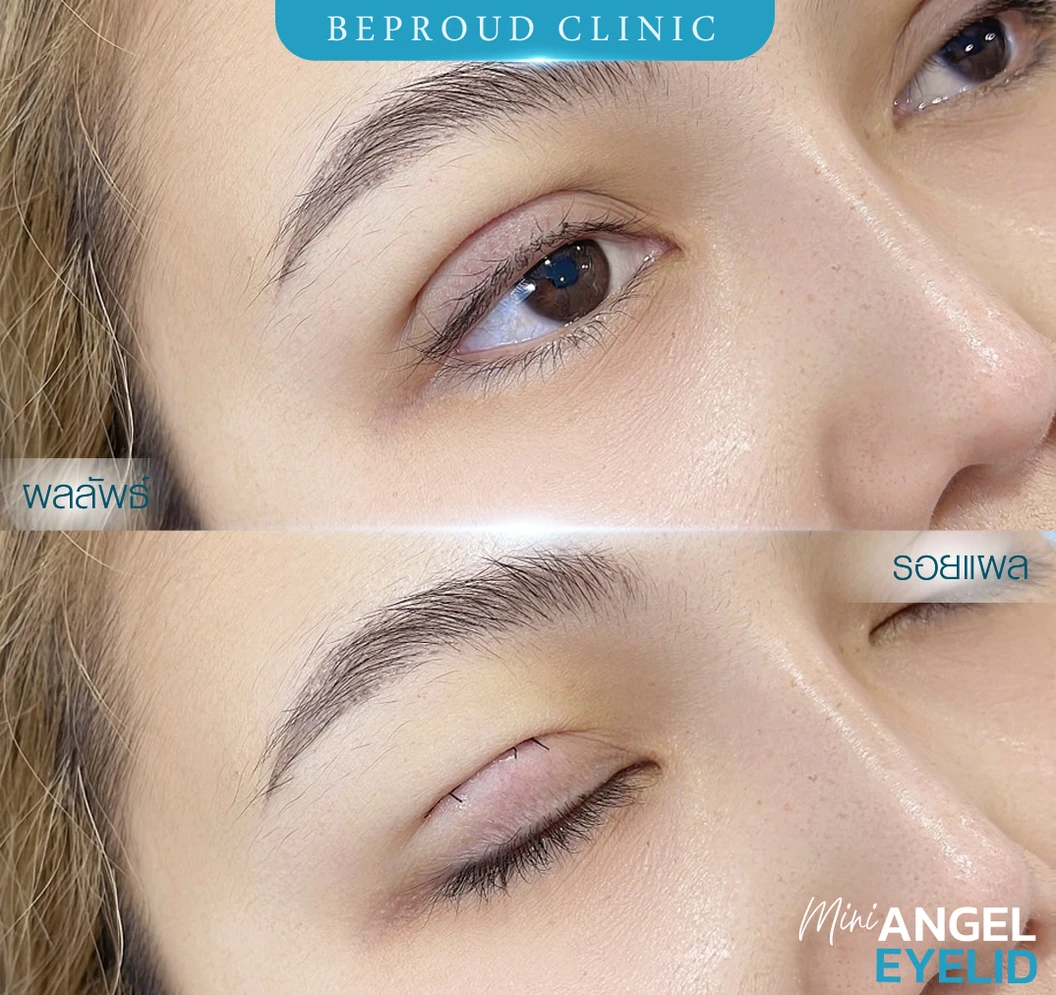 ทำตาสองชั้น แบบกรีดยาว แผลมินิ (แผลเล็กไม่ถึง 1 ซม.) สำหรับเคสทำครั้งแรกและรีวิว