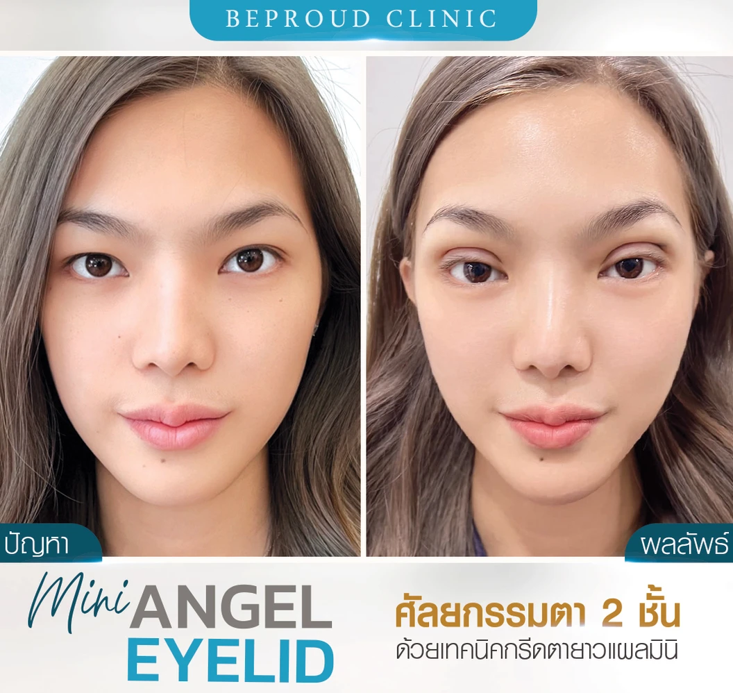 ทำตาสองชั้น แบบกรีดยาว แผลมินิ (แผลเล็กไม่ถึง 1 ซม.) สำหรับเคสทำครั้งแรกและรีวิว