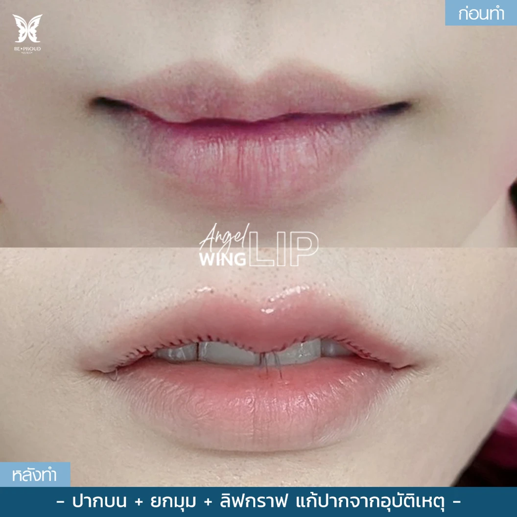 ทำปากกระจับริมฝีปากบน สำหรับเคสทำครั้งแรกและรีวิว