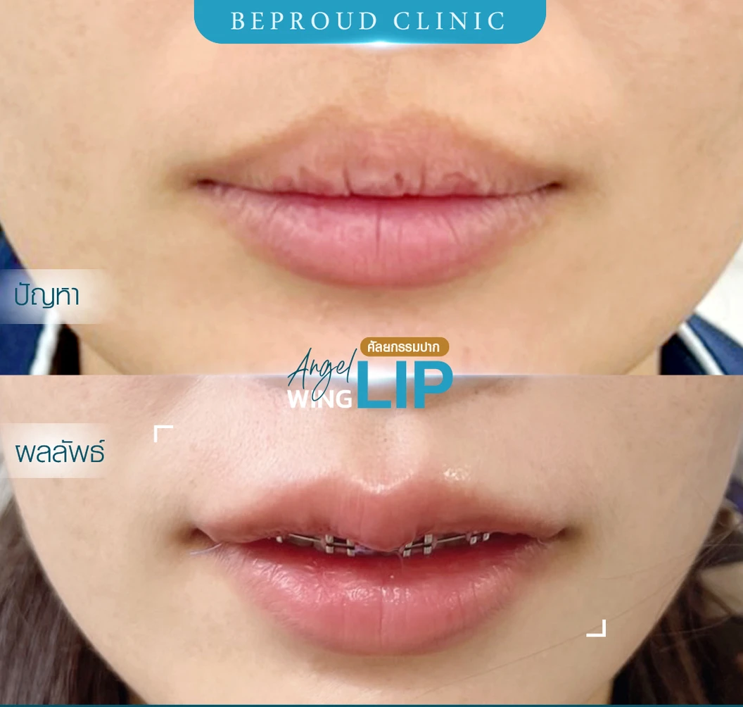 ทำปากกระจับริมฝีปากบน สำหรับเคสทำครั้งแรกและรีวิว