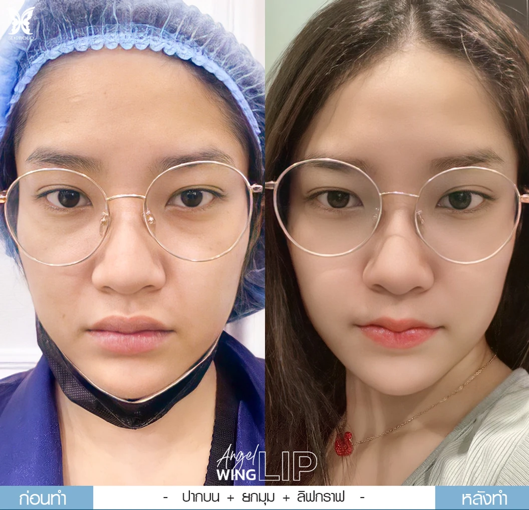 ทำปากกระจับริมฝีปากบน สำหรับเคสทำครั้งแรกและรีวิว
