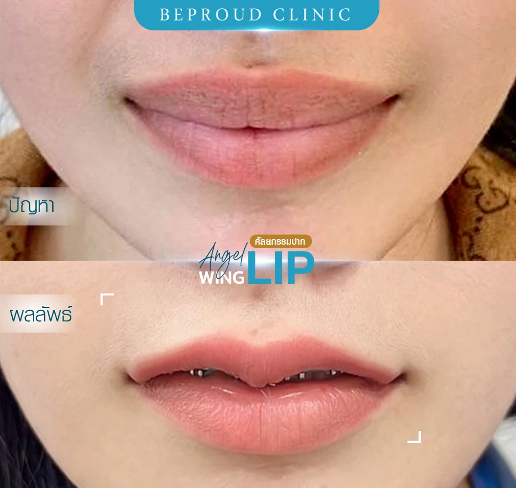 ทำปากกระจับริมฝีปากบน สำหรับเคสทำครั้งแรกและรีวิว