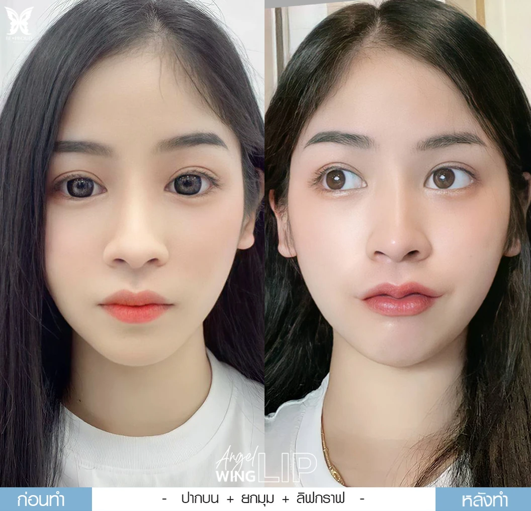 ทำปากกระจับริมฝีปากบน สำหรับเคสทำครั้งแรกและรีวิว