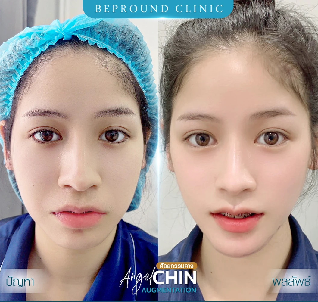 เสริมคาง ด้วยซิลิโคนอเมริกาขาสั้นหรือขายาว เทคนิค Angel Chin (ปลายมน ออกแบบเฉพาะบุคคล) สำหรับเคสทำครั้งแรกและรีวิว