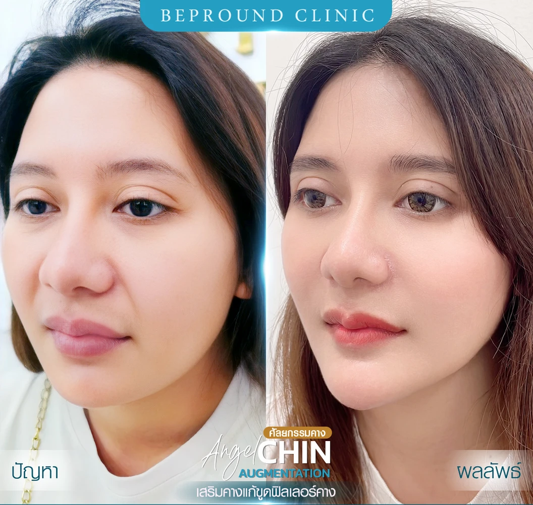 เสริมคาง ด้วยซิลิโคนอเมริกาขาสั้นหรือขายาว เทคนิค Angel Chin (ปลายมน ออกแบบเฉพาะบุคคล) สำหรับเคสทำครั้งแรกและรีวิว