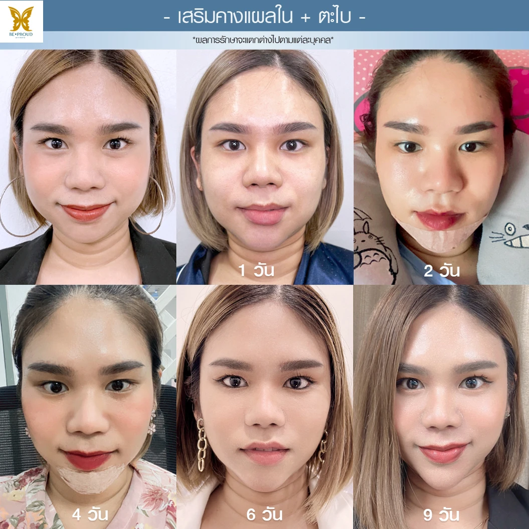 เสริมคาง ด้วยซิลิโคนอเมริกาขาสั้นหรือขายาว เทคนิค Angel Chin (ปลายมน ออกแบบเฉพาะบุคคล) สำหรับเคสทำครั้งแรกและรีวิว