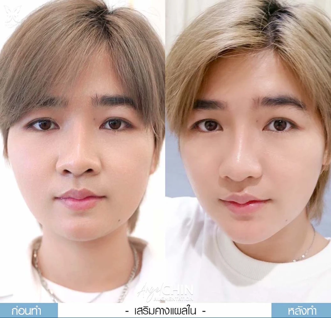 เสริมคาง ด้วยซิลิโคนอเมริกาขาสั้นหรือขายาว เทคนิค Angel Chin (ปลายมน ออกแบบเฉพาะบุคคล) สำหรับเคสทำครั้งแรกและรีวิว