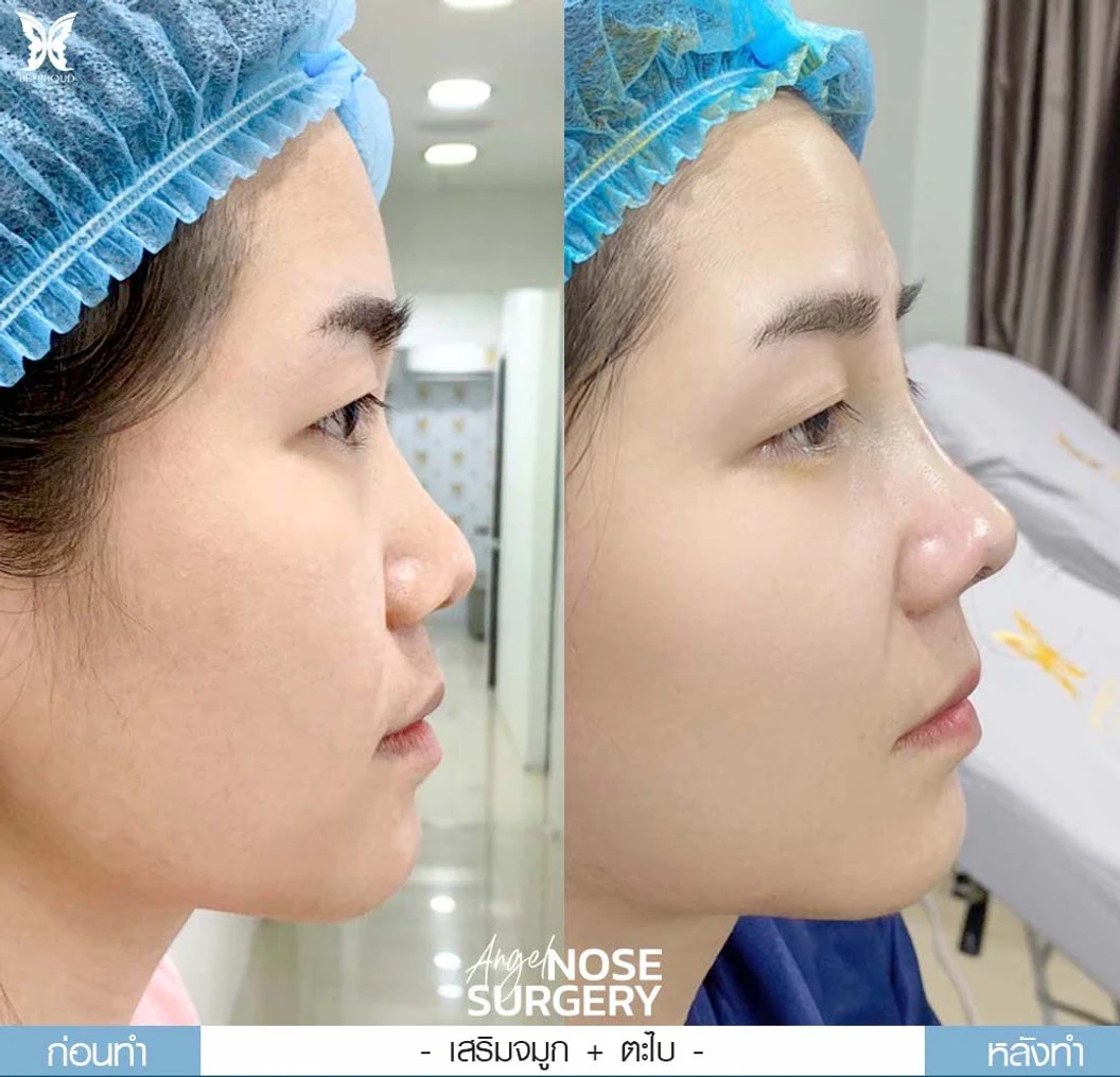 เสริมจมูก ด้วยซิลิโคน Mantis ทรง Slope Angle (สันจมูกสโลป ปลายจมูกพุ่ง) สำหรับเคสทำครั้งแรกและรีวิว
