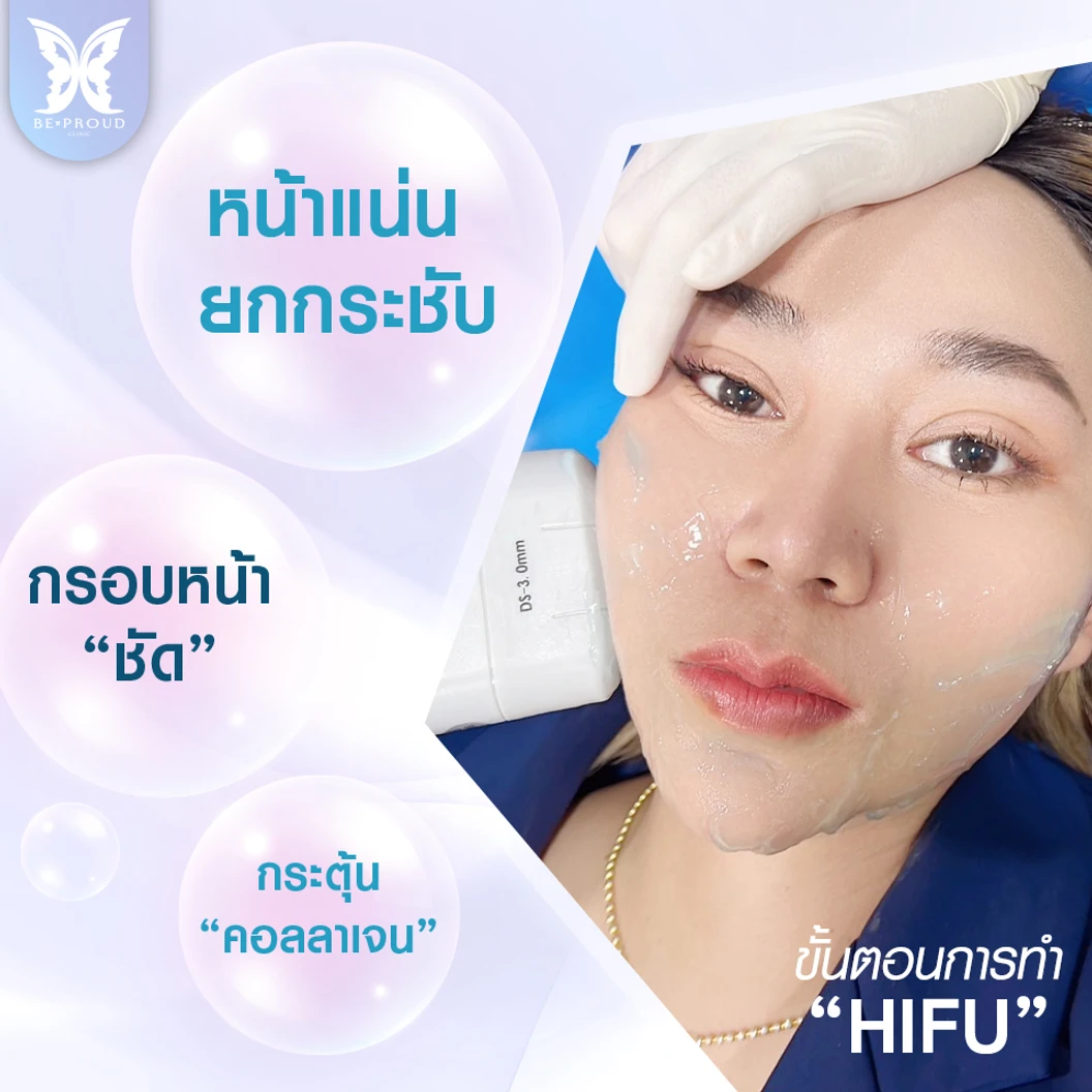 ทำ HIFU จำนวนช็อตขึ้นอยู่กับแพทย์ประเมิน บริเวณทั่วใบหน้า 1 ครั้ง
