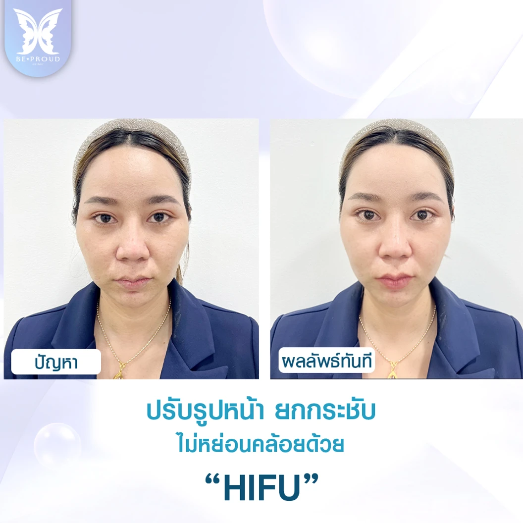 ทำ HIFU จำนวนช็อตขึ้นอยู่กับแพทย์ประเมิน บริเวณทั่วใบหน้า 1 ครั้ง