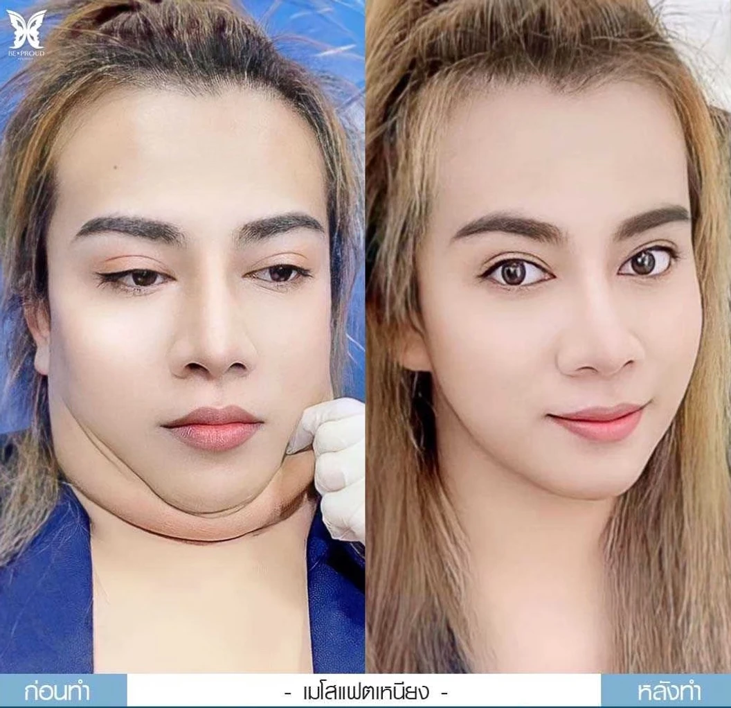 โปรแกรมเมโสแฟต 10 ซีซี เพื่อสลายไขมันส่วนเกินทั่วใบหน้า 1 ครั้ง