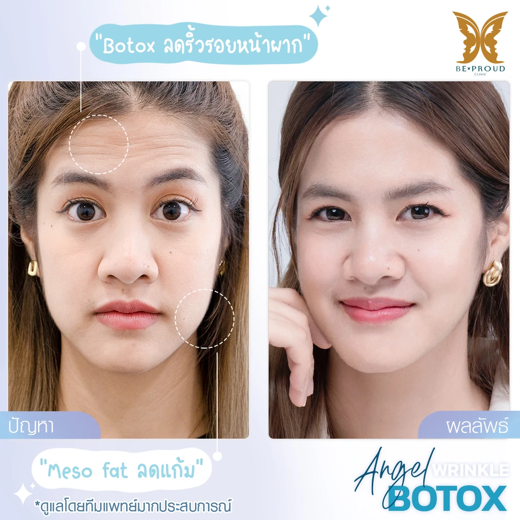 โปรแกรมเมโสแฟต 10 ซีซี เพื่อสลายไขมันส่วนเกินทั่วใบหน้า 1 ครั้ง