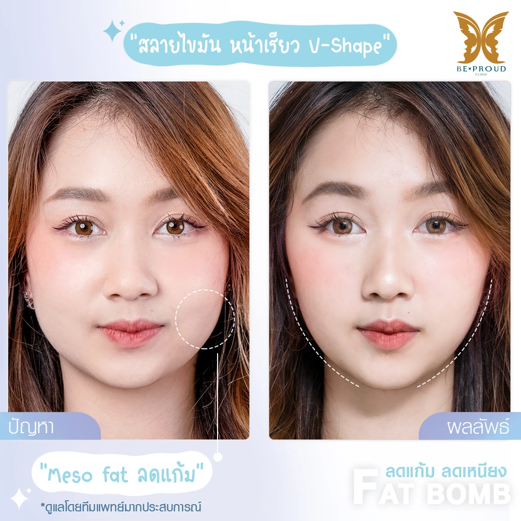 โปรแกรมเมโสแฟต 10 ซีซี เพื่อสลายไขมันส่วนเกินทั่วใบหน้า 1 ครั้ง