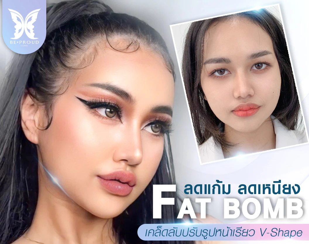 โปรแกรมเมโสแฟต 10 ซีซี เพื่อสลายไขมันส่วนเกินทั่วใบหน้า 1 ครั้ง