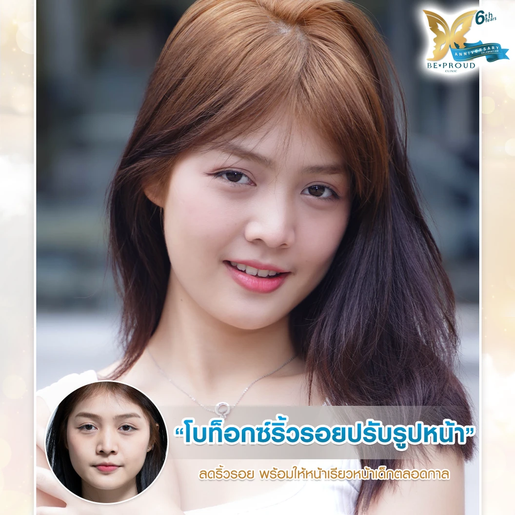 โปรแกรมโบท็อกซ์ 100 ยูนิต (บริเวณที่มีปัญหา)