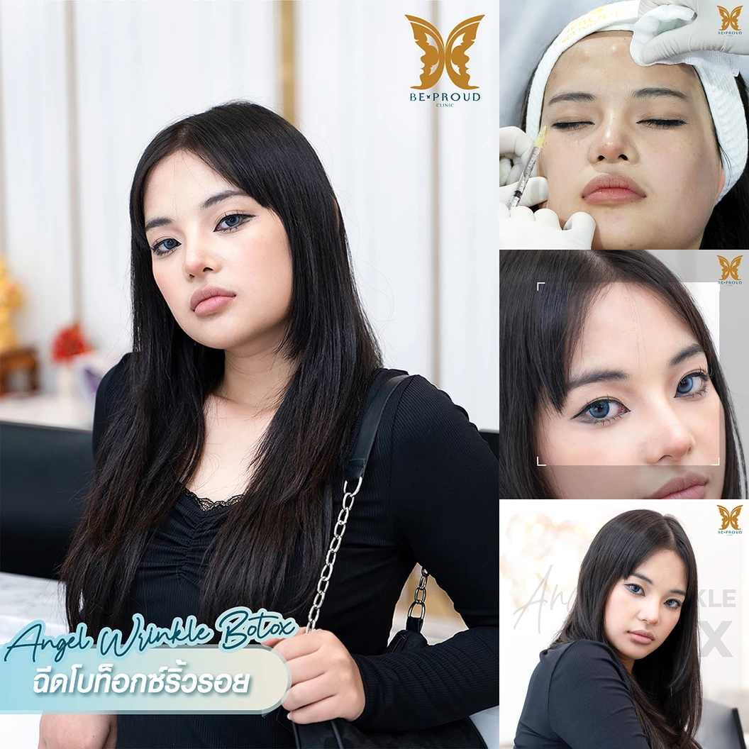 โปรแกรมโบท็อกซ์ 100 ยูนิต (บริเวณที่มีปัญหา)