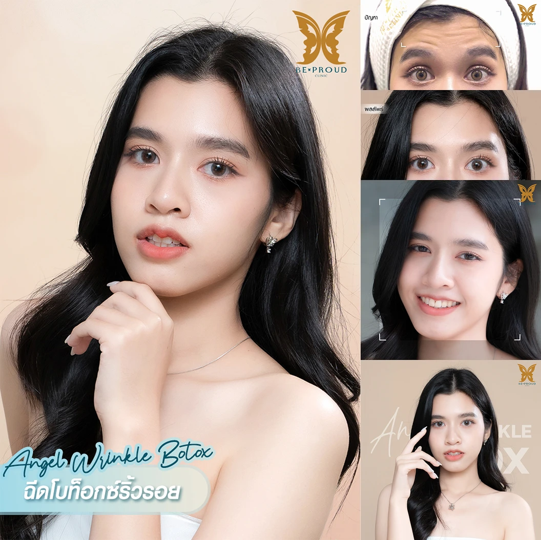 โปรแกรมโบท็อกซ์ 100 ยูนิต (บริเวณที่มีปัญหา)