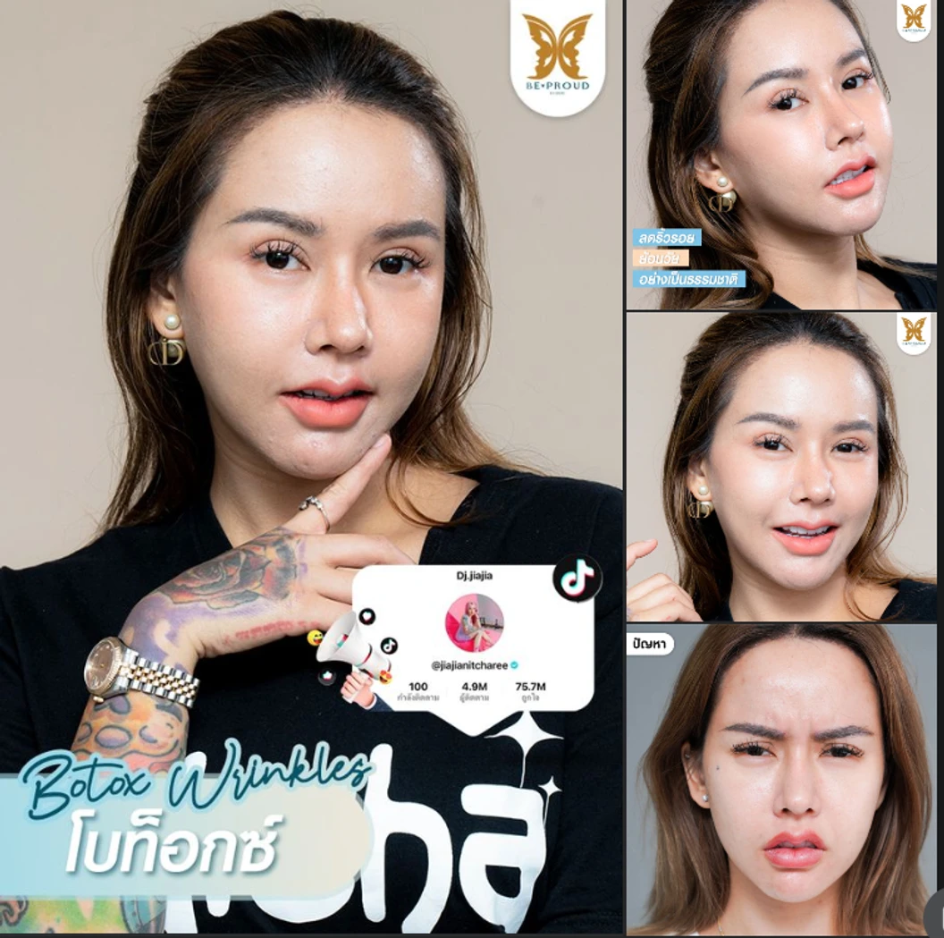 โปรแกรมโบท็อกซ์ 100 ยูนิต (บริเวณที่มีปัญหา)