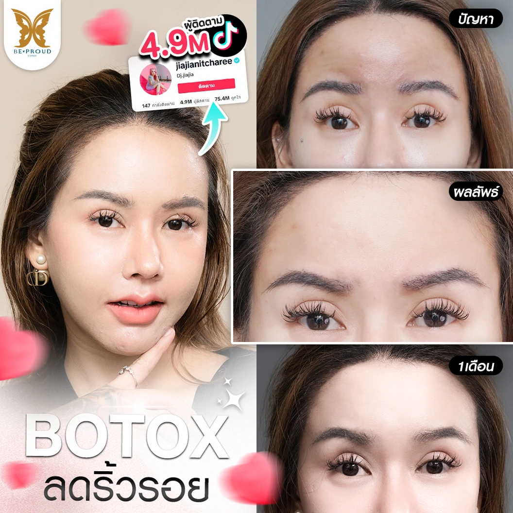 โปรแกรมโบท็อกซ์ 100 ยูนิต (บริเวณที่มีปัญหา)