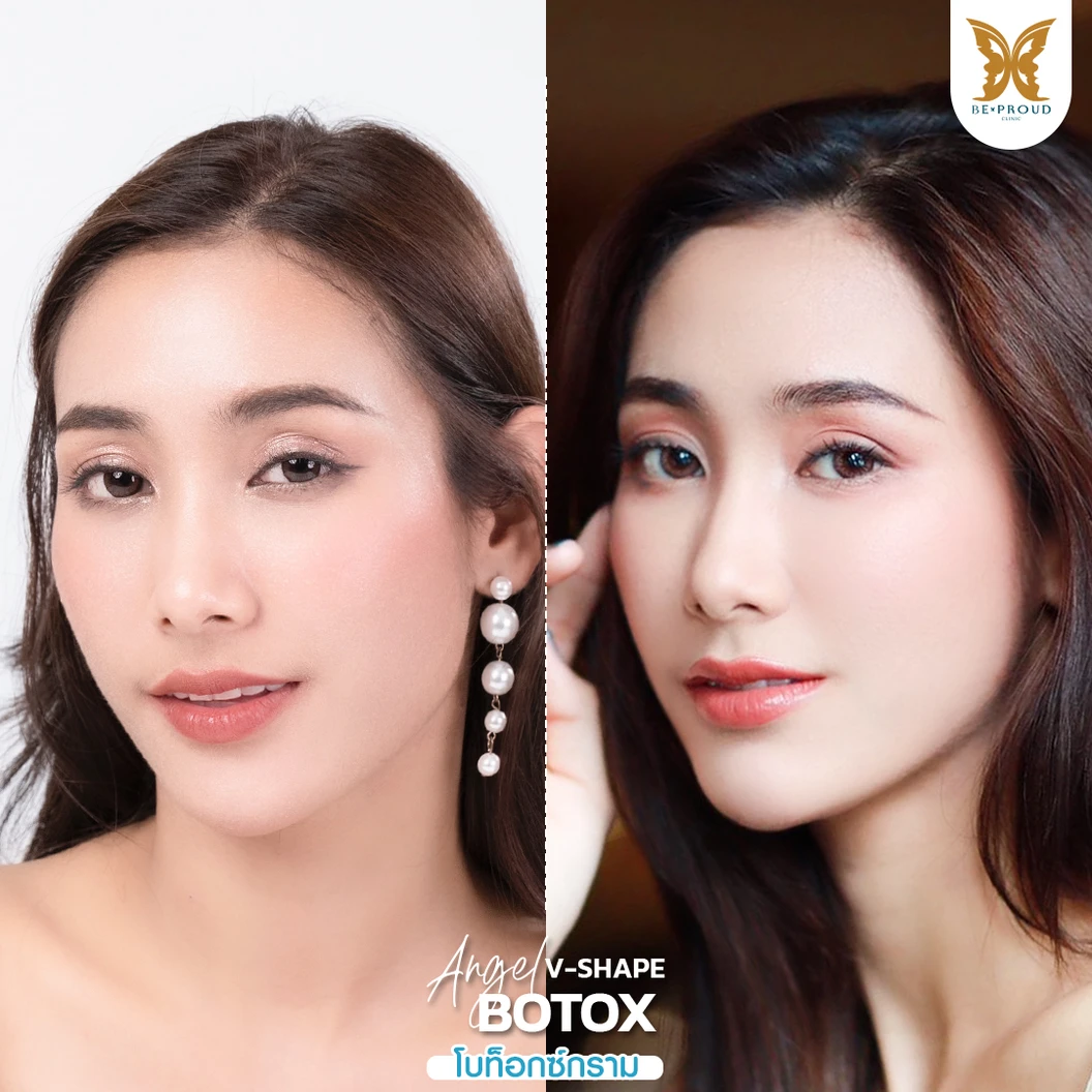 โปรแกรมโบท็อกซ์ 100 ยูนิต (บริเวณที่มีปัญหา)