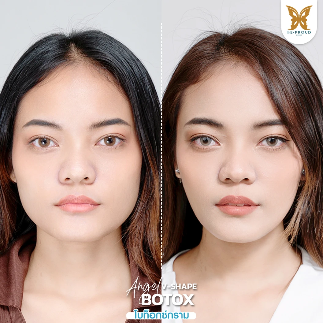 โปรแกรมโบท็อกซ์ 100 ยูนิต (บริเวณที่มีปัญหา)