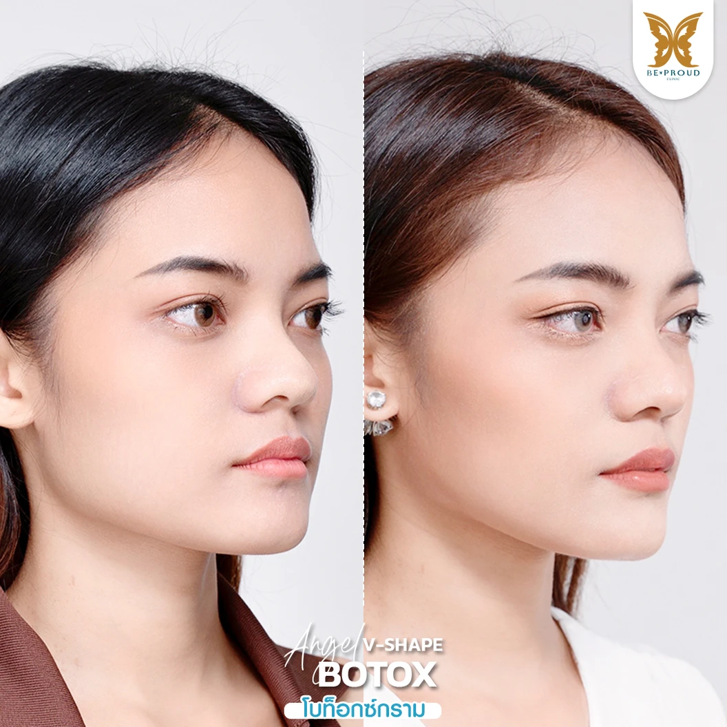 โปรแกรมโบท็อกซ์ 100 ยูนิต (บริเวณที่มีปัญหา)